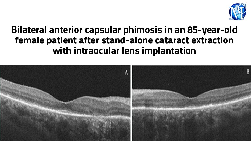 Bilateral anterior capsular phimosis in an 85-year-old female #patient after stand-alone #cataract #extraction with intraocular #lens implantation, published in Advances in #Ophthalmology & Visual System by Thanh, et al. medcraveonline.com/AOVS/AOVS-14-0… #eye #laser #surgery #medicine