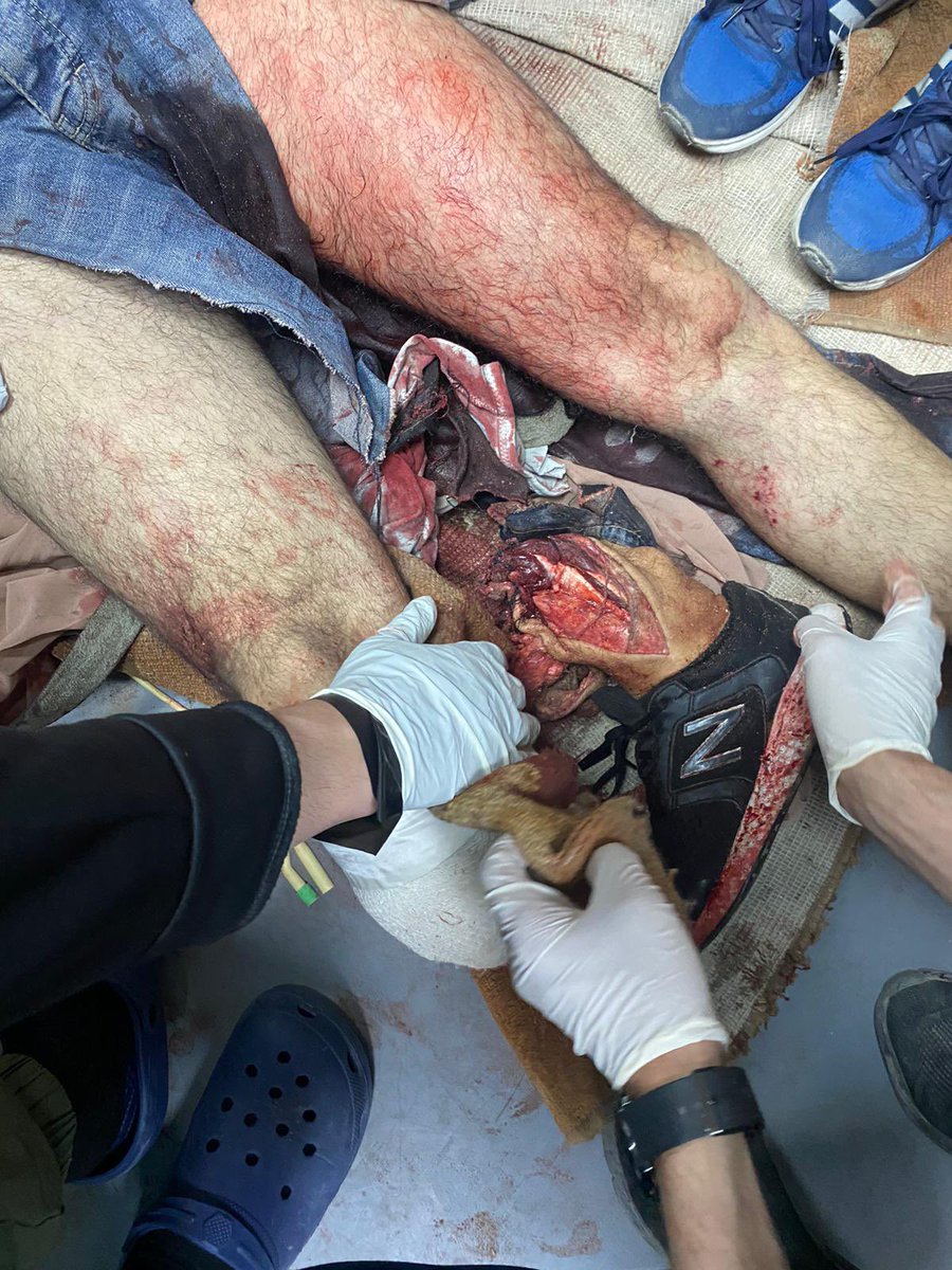 Journalist Samy Barhoum's leg after it was amputated, targeted by an artillery shell from the occupation army in Nuseirat. This is what happens to journalists in Gaza