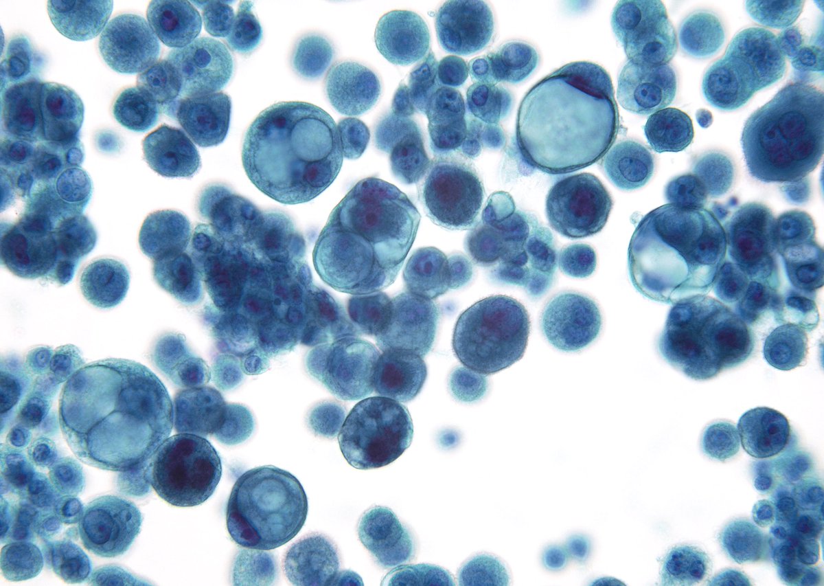 An impressive cytomorphology in a pleural fluid from this morning’s signout - Patient has a history of breast carcinoma with mixed ductal and lobular features. (Cytospin)