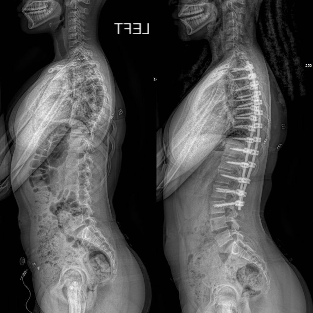 Dr. Hariharan's 13-year-old patient from Haiti, Angie, had scoliosis and was, understandably, scared of surgery. With guidance and support from our team, she went through with the procedure and is now healthier and happier!