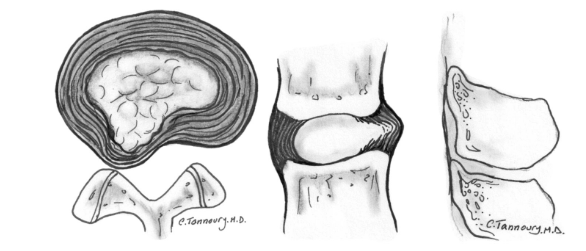 'Bulging Disc'...'Ruptured Disc'...'Slipped Disc'.....'Prolapsed Disc'....'Burst Disc'... The correct term for all of these is a 'Disc Herniation' & should be the term used to avoid confusion (and adding stress to the patient). Here are the different types in the lumbar spine🧵