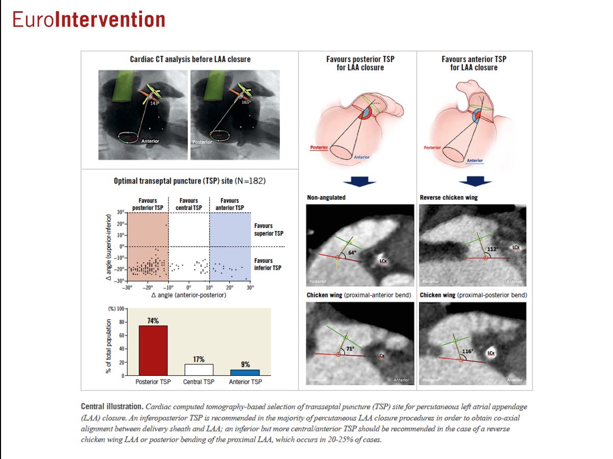 This study investigated the ideal transseptal puncture site for left atrial appendage closure by assessing the anatomical relationship between the left atrial appendage and the fossa ovalis using cardiac computed tomography. The results suggested adjusting the puncture site based