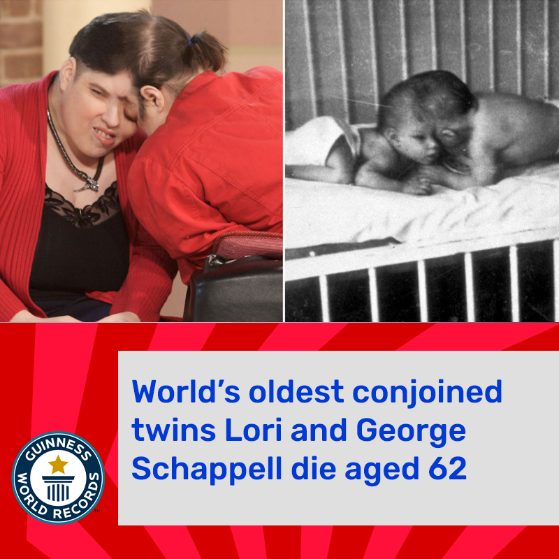 Les jumeaux siamois les plus âgés du monde sont morts