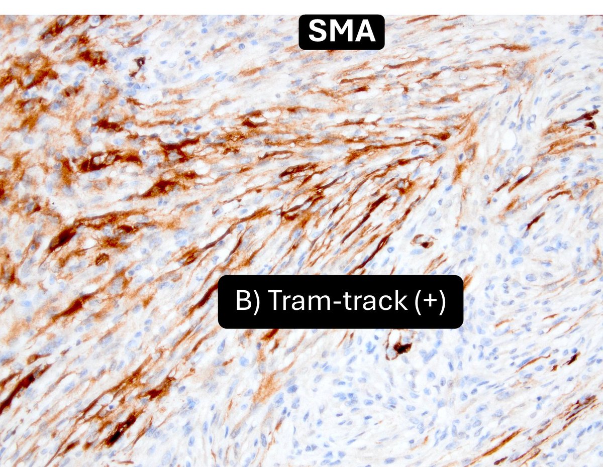 DrCycloPath's tweet image. A or B = myofibroblasts?
#bstpath #pathtwitter #pathresidents #surgpath #dermpath #ihc