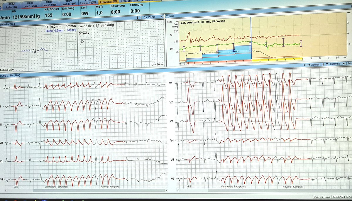 Recovery phase of exercise test. Today. #cardiac #stresstest #ECG
