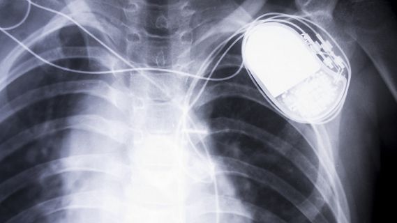 🫀 Un estudi de l'<a href="/hospitaldelmar/">Hospital del Mar</a> demostra que canviar el punt d'estimulació dels marcapassos dins del cor ajuda a reduir complicacions posteriors.

🎙️ <a href="/Anna_Baneres/">Anna Bañeres</a> | <a href="/radio4_rne/">radio4_rne</a> 

📲 rtve.es/a/16057499