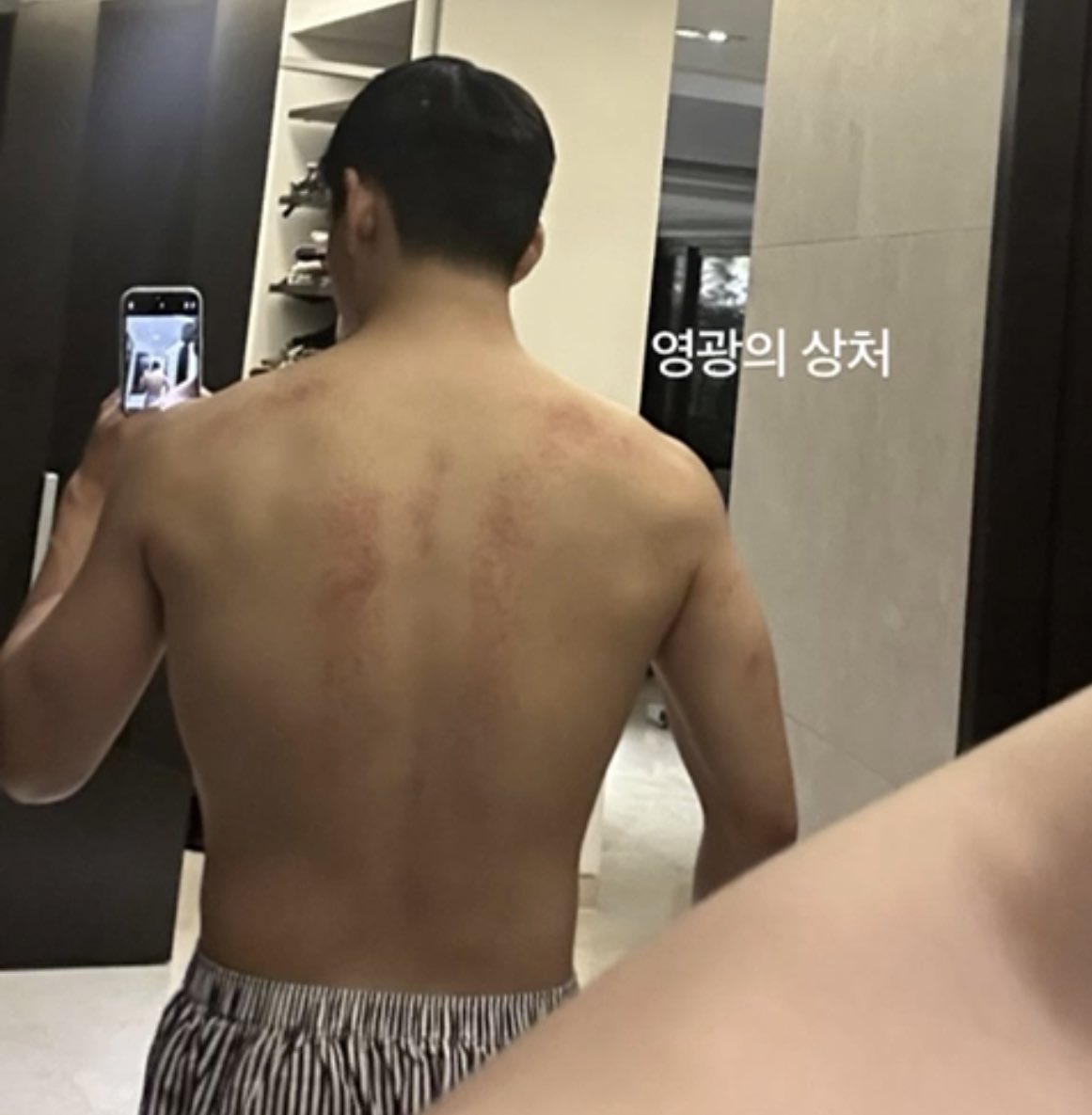 Male fan wrote of similar scars he got while in the military on Korean forum 👤I have scars like those from being in the military I went 7 years ago, and I still have scars like that on my waist area so I can relate 😭 I think it's from marching with all the military gear or…