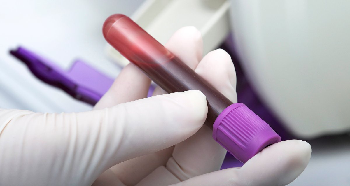 Researchers are getting closer to being able to reliably screen for pancreatic cancer by conducting tests on a person’s blood. wb.md/3JfIDHG
