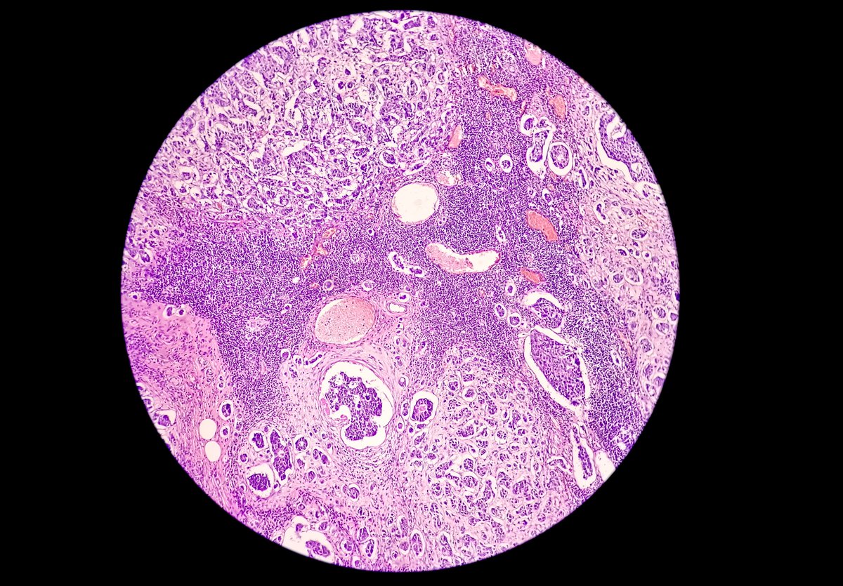 Is the National Breast Pathology Update Course of interest? This virtual 1 day course will cover aspects of pathology diagnosis including lectures and workshops. Join here: ow.ly/wXTT50R92Uf for 5 #CPD credits.