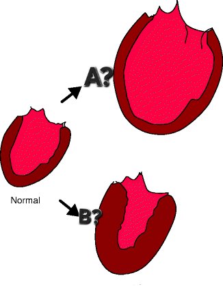 What are the two types of heart hypertrophies shown below?
A?
B?
#MedTwitter #MedEd #MedClips