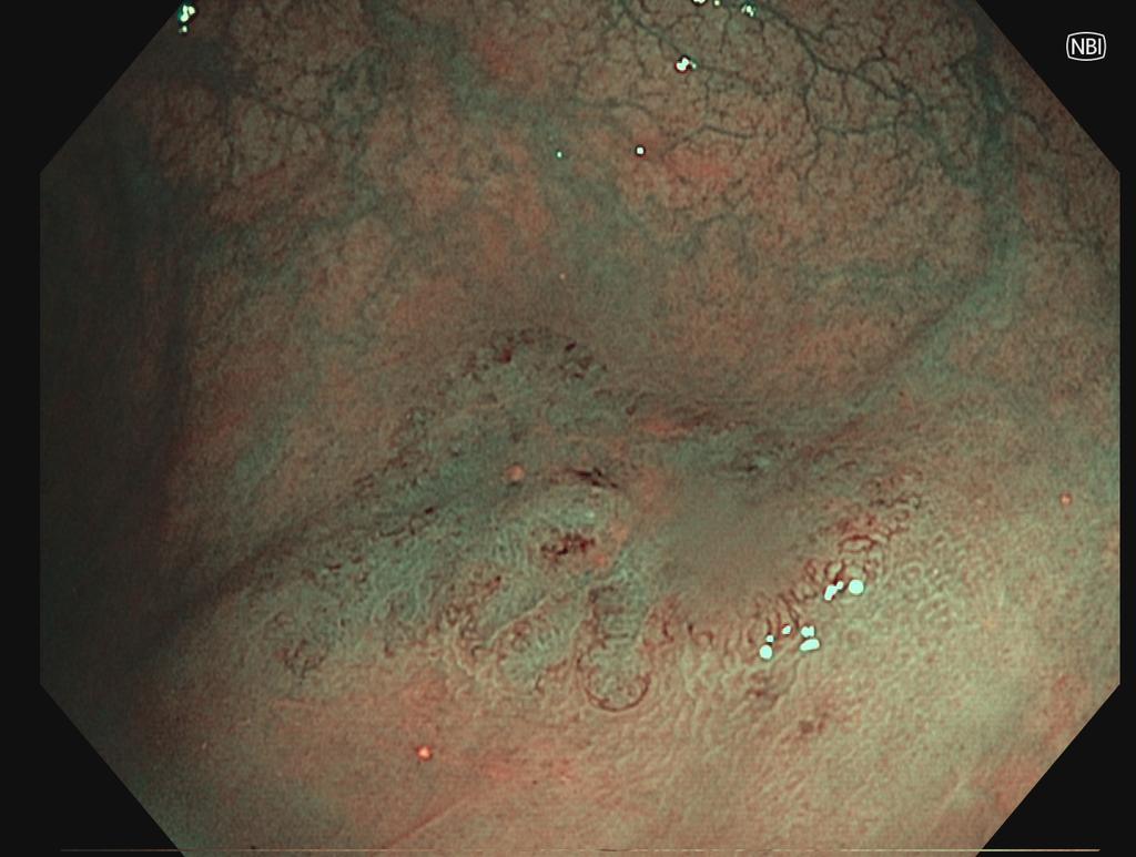 Another missed lesion >10 mm. Path pending. Lesion was noticed during third colono for follow up after pEMR of another LST.