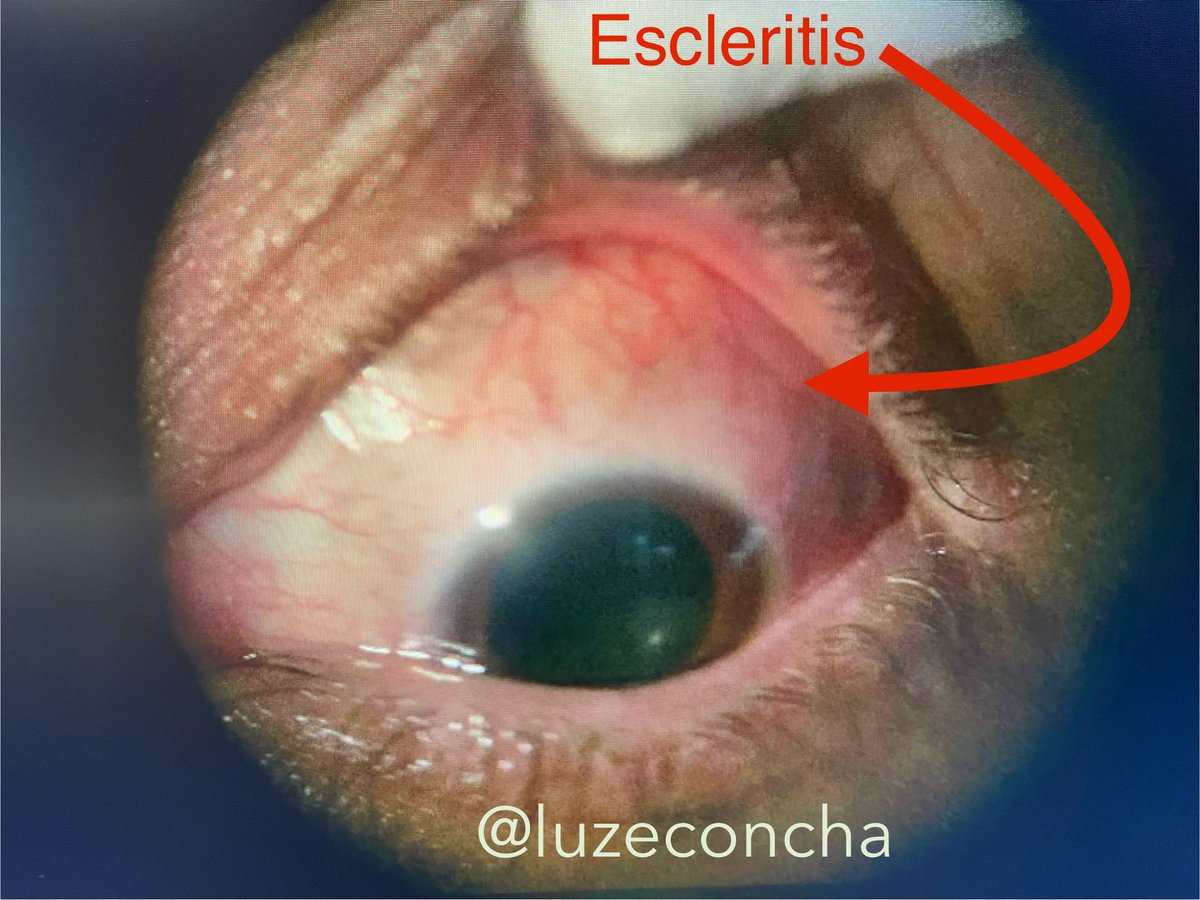 🔴Escleritis🔴 Causa de #ojorojo #dolor Descartar enfermedad autoinmune e infecciosa #uveitis #saludvisual 👁️👁️