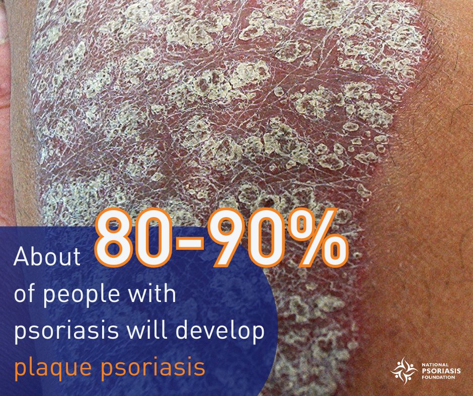 If you are living with psoriasis there is a huge chance you have experienced #plaquepsoriasis. Plaques appear as raised, inflamed, and scaly patches of skin that may also be itchy and painful. Head to our website to learn more: psoriasis.org/plaque/
