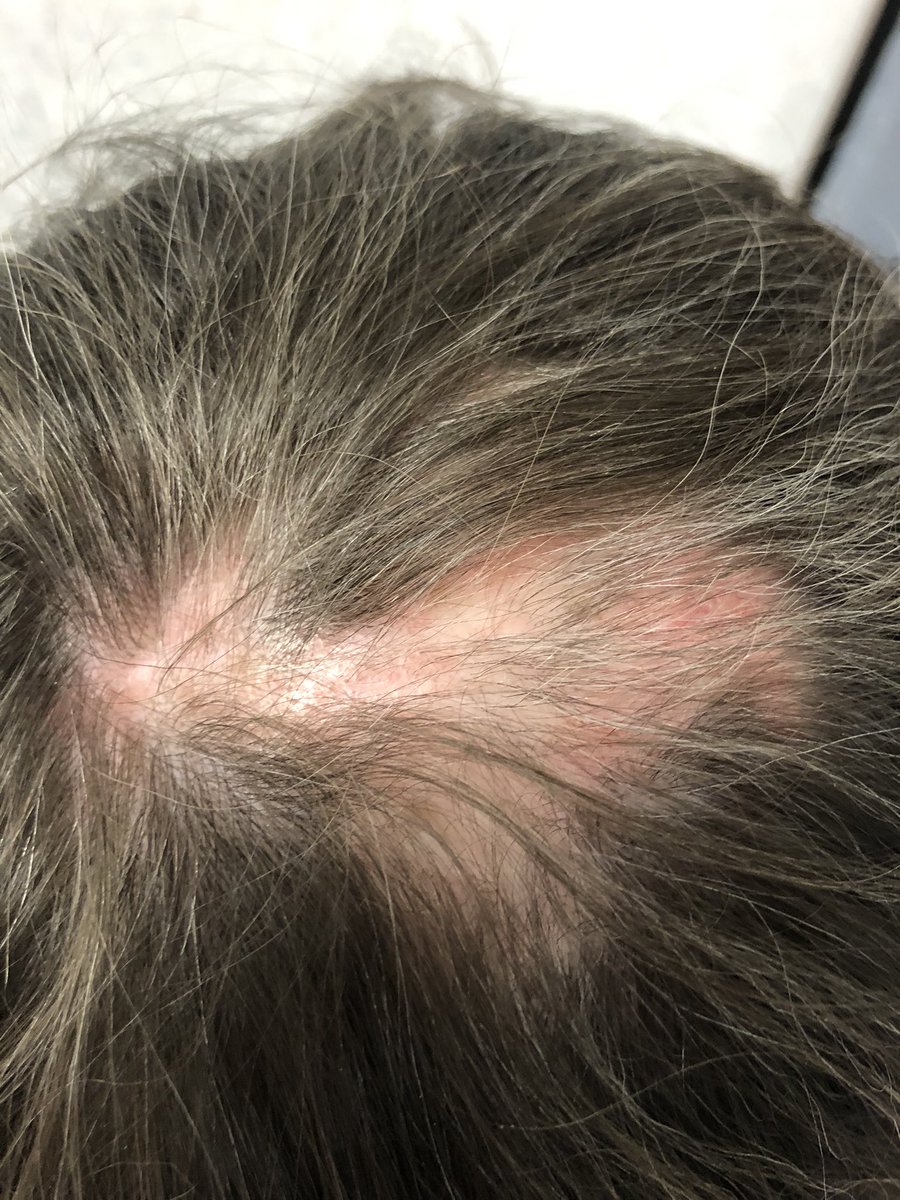 Hope for #bald spots - immune related 

#baricitinib approved for
#alopecia #areata 
In many countries 

#Baricitinib failed in Phase III for #SLE but May help this #concomitant #immune problem

#JAK2i
#MedEd #MedX #RheumEd #RheumX
#DermX #DermEd 

#ClinicalPearl