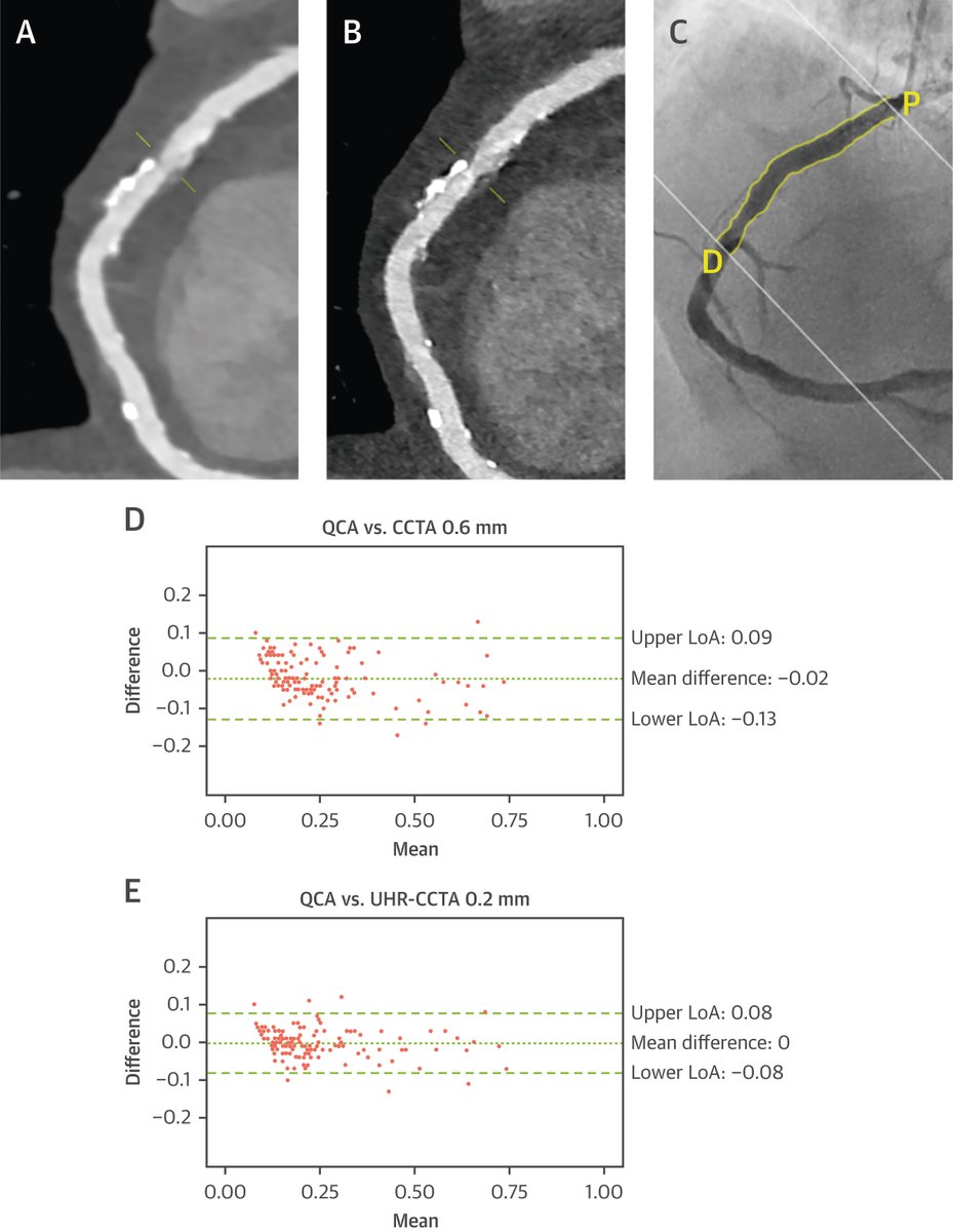 Seeing even more clearly through photon-counting CT (PCCT)? PCCT through in-plane resolution to 0.11mm and through plane resolution to 0.16mm improved coronary stenosis quantification using 3D-QCA as the reference standard. bit.ly/4awzMg5 #YesCCT #JACCIMG @MatthEberhard