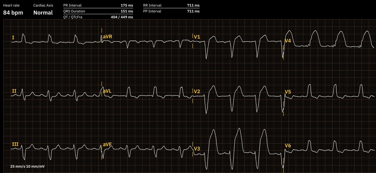 This ECG was sent in very poor quality, the original source is unknown to me. The recording was improved with PMcardio. Diagnosis?