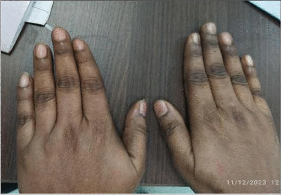 A case of subclinical #myopathy with predominant blackish pigmentation over the digital tip and knuckles of the left fingers with anti-Mi2b antibody strongly 👉rdcu.be/dC7BD