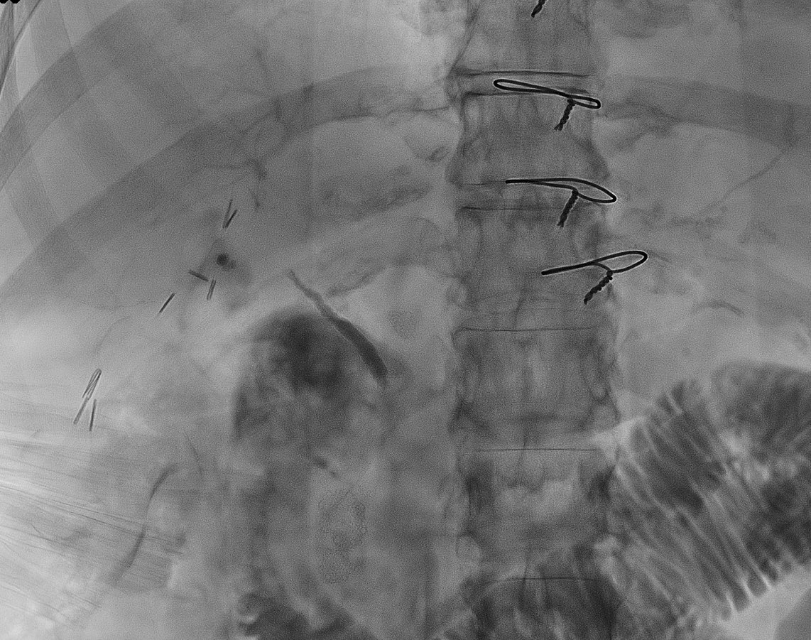IR_Cain's tweet photo. Cystic duct stump leak was embolized with #Obsidio conformable embolic. Post embo cholangiogram demonstrated no further filing of the cystic duct or bile leak. All drains (including biliary access) were removed. No leak recurrence after several months. #IRad https://t.co/98MOzLavLD