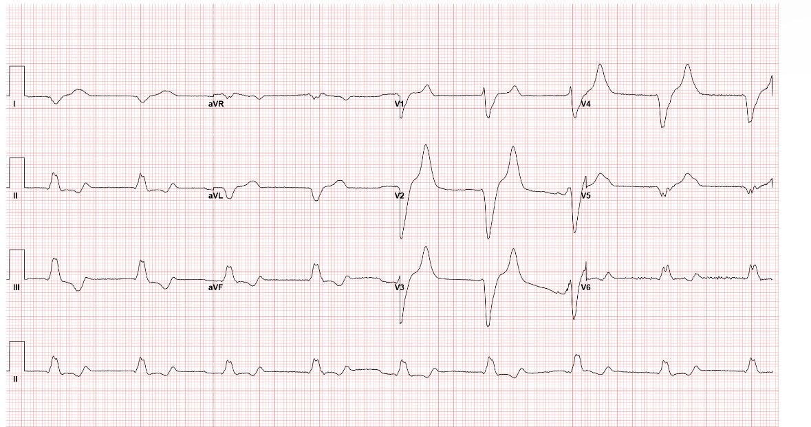 ER calls for abnormal EKG, Calcium was given before labs available. Memorize the pattern of hyperkalemia. Potassium came out to be 8.5.