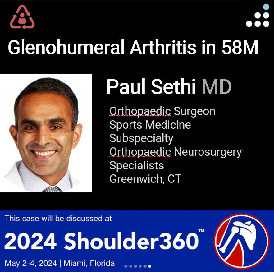 Here is a new case by <a href="/PaulSethiMD/">Paul Sethi, MD</a> 

GLENOHUMERAL ARTHRITIS IN 58M

This case will be debated at the 2024 <a href="/shoulder360/">Shoulder360 Course</a>  meeting in Miami, Florida, May 2-4, 2024.

How would you manage this patient?

Share your opinion with the Orthobullets community by joining the discussion and