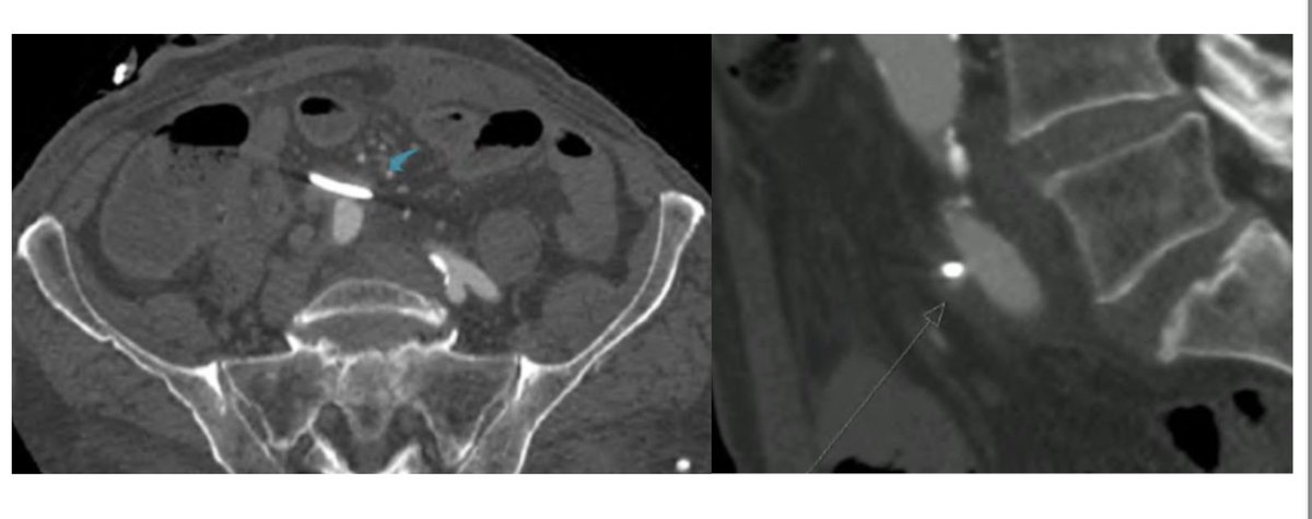 82-year-old, male with radical cystoprostatectomy and cutaneous ureterostomy for a vesical neoplasm. At the emergency department was haemodinamically unstable and cutaneous ureterostomy was actively bleeding. Haemoglobin of 7.5g/dl. CTA is below. Angiography was unconclusive.
