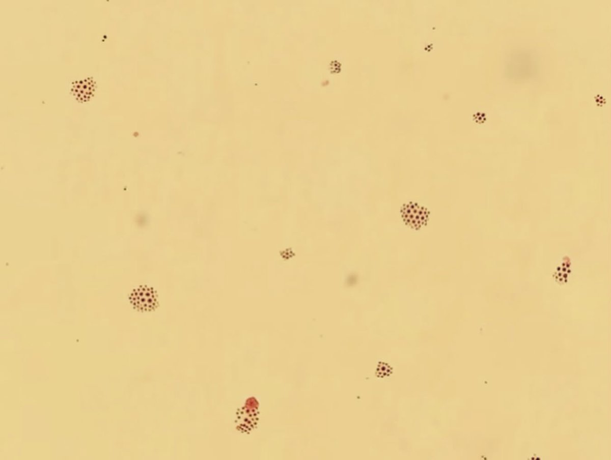 microtech84's tweet image. Cryptococcus neoformans. Young male, hiv+. First pic - crypto antigen on serum. Titer performed &amp;amp; is &amp;gt;=1:2560.  2nd pic is csf gst on low. 3rd pic gst on high. 4th is India ink. #bacteriology #microbiology #cryptococcus