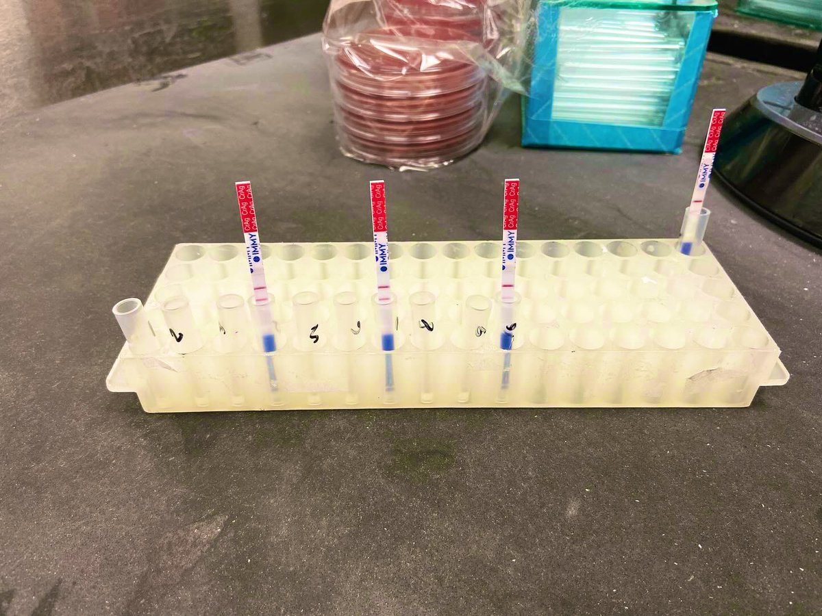 microtech84's tweet image. Cryptococcus neoformans. Young male, hiv+. First pic - crypto antigen on serum. Titer performed &amp;amp; is &amp;gt;=1:2560.  2nd pic is csf gst on low. 3rd pic gst on high. 4th is India ink. #bacteriology #microbiology #cryptococcus