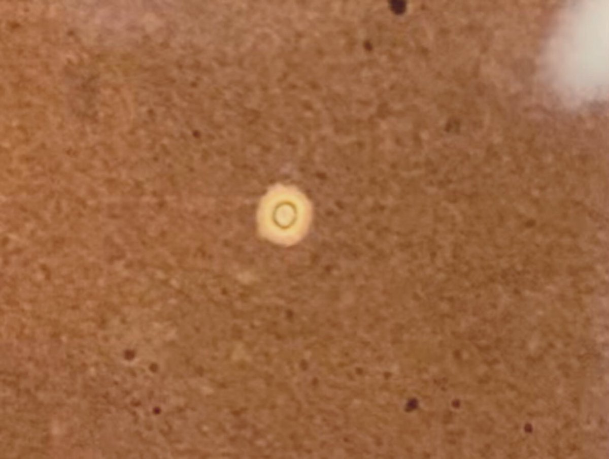 microtech84's tweet image. Cryptococcus neoformans. Young male, hiv+. First pic - crypto antigen on serum. Titer performed &amp;amp; is &amp;gt;=1:2560.  2nd pic is csf gst on low. 3rd pic gst on high. 4th is India ink. #bacteriology #microbiology #cryptococcus