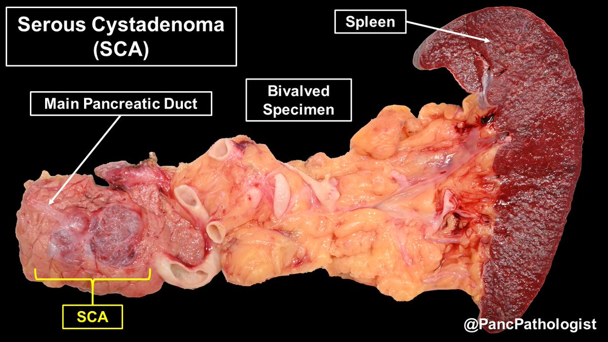 PancPathologist's tweet photo. Although benign, a subset of Serous Cystadenomas (SCAs) can grow &amp; occlude the #pancreatic duct. In addition to VHL, these SCAs have mutations in TP53 &amp; the hTERT promoter. Pic#3 in formalin to bring out their architecture. #Pathology #GIPath #Pancreas #PrecisionMedicine https://t.co/jEfrZykbbN