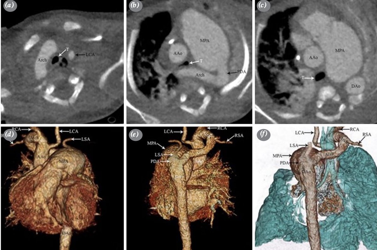 tjtcvs's tweet photo. A rare case with tracheal compression: Circumflex aorta

https://t.co/iJpIh5T7sp https://t.co/TJHxg3ZlmL