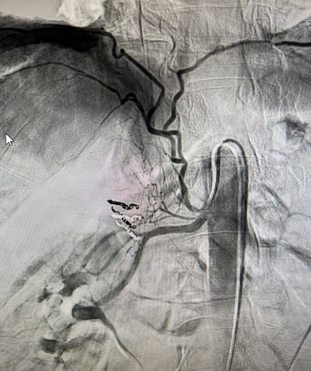 Carin Gonsalves, MD, FSIR (@carin_gonsalves) on Twitter photo Not sure I have seen this before! <a href="/SIRspecialists/">Society of Interventional Radiology</a> <a href="/JeffCVIR/">Jefferson Interventional Radiology</a> <a href="/womenirads/">WomeninIR</a><a href="/kantonIR/">Kevin Anton MD, PhD</a> <a href="/WomenAs1/">Women As One</a> <a href="/SirtexMedical/">Sirtex Medical</a> <a href="/allison_tan_md/">Allison Tan, MD</a> <a href="/SteveToppIR/">Stephen Topper, MD</a> <a href="/RobertFordMD/">Robert Ford, MD</a> Not sure I have seen this before! <a href="/SIRspecialists/">Society of Interventional Radiology</a> <a href="/JeffCVIR/">Jefferson Interventional Radiology</a> <a href="/womenirads/">WomeninIR</a><a href="/kantonIR/">Kevin Anton MD, PhD</a> <a href="/WomenAs1/">Women As One</a> <a href="/SirtexMedical/">Sirtex Medical</a> <a href="/allison_tan_md/">Allison Tan, MD</a> <a href="/SteveToppIR/">Stephen Topper, MD</a> <a href="/RobertFordMD/">Robert Ford, MD</a>