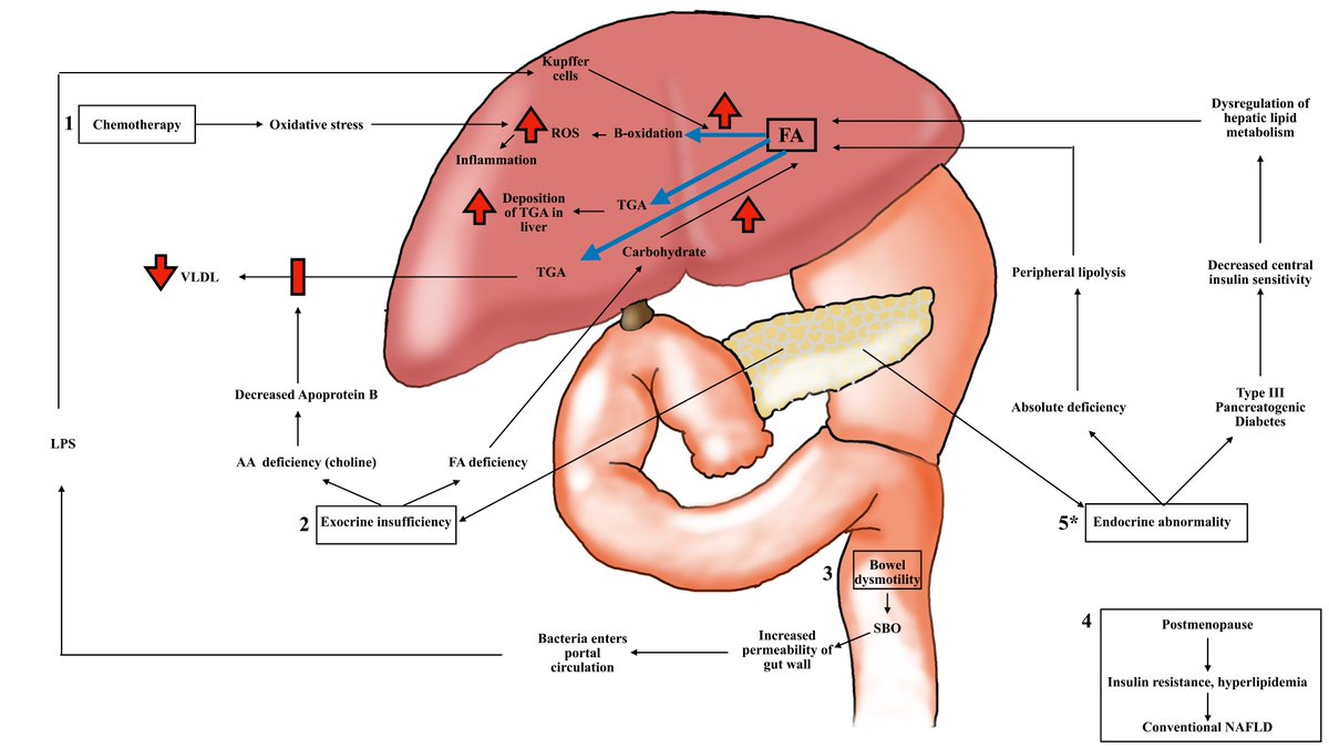 Kavin Sugumar, MD (@kavinsugumar) on Twitter photo Check out our #metaanalysis looking at risk factors of developing NAFLD following #pancreatectomy. ♀️ gender, PDAC, adjuvant CT were significantly associated. #NAFLD
<a href="/JordanMWinterMD/">Jordan M. Winter MD</a> <a href="/TheNotoriousHPB/">Lee M. Ocuin MD, FACS</a> <a href="/jj_hue/">JJ Hue</a> <a href="/AmmoriJohn/">John Ammori</a> <a href="/JournalofGISurg/">JOGS</a> <a href="/SSATNews/">SSAT</a>
sciencedirect.com/science/articl… Check out our #metaanalysis looking at risk factors of developing NAFLD following #pancreatectomy. ♀️ gender, PDAC, adjuvant CT were significantly associated. #NAFLD
<a href="/JordanMWinterMD/">Jordan M. Winter MD</a> <a href="/TheNotoriousHPB/">Lee M. Ocuin MD, FACS</a> <a href="/jj_hue/">JJ Hue</a> <a href="/AmmoriJohn/">John Ammori</a> <a href="/JournalofGISurg/">JOGS</a> <a href="/SSATNews/">SSAT</a>
sciencedirect.com/science/articl…
