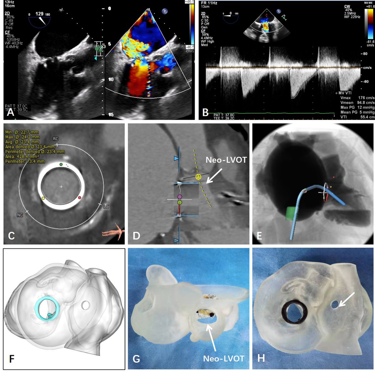 SusieSu11733465's tweet photo. 🍀Welcome to read the paper in #RCM Volume 24 (2023)
🎊"Transcatheter Mitral Valve-in-Valve Implantation Applying a Long Pre-Curved Sheath for Patients with Degenerated Bioprosthetic Mitral Valve"
#TMViV #mitralvalve #intervention
🔓Full Text
https://t.co/RWRX0rvwzc https://t.co/f7c7G7p34R