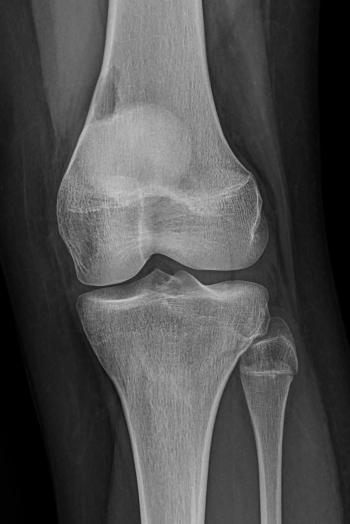 1/4/2024. 🟠🔍Awaiting MRI and lateral X-ray for a 17-year-old adolescent. Suspected diagnosis pending. Describe the finding and let's delve into differentials. 💡Stay tuned. 🧐 #MedTwitter #MSKRadiology #bonetumor #radiology #XRAY