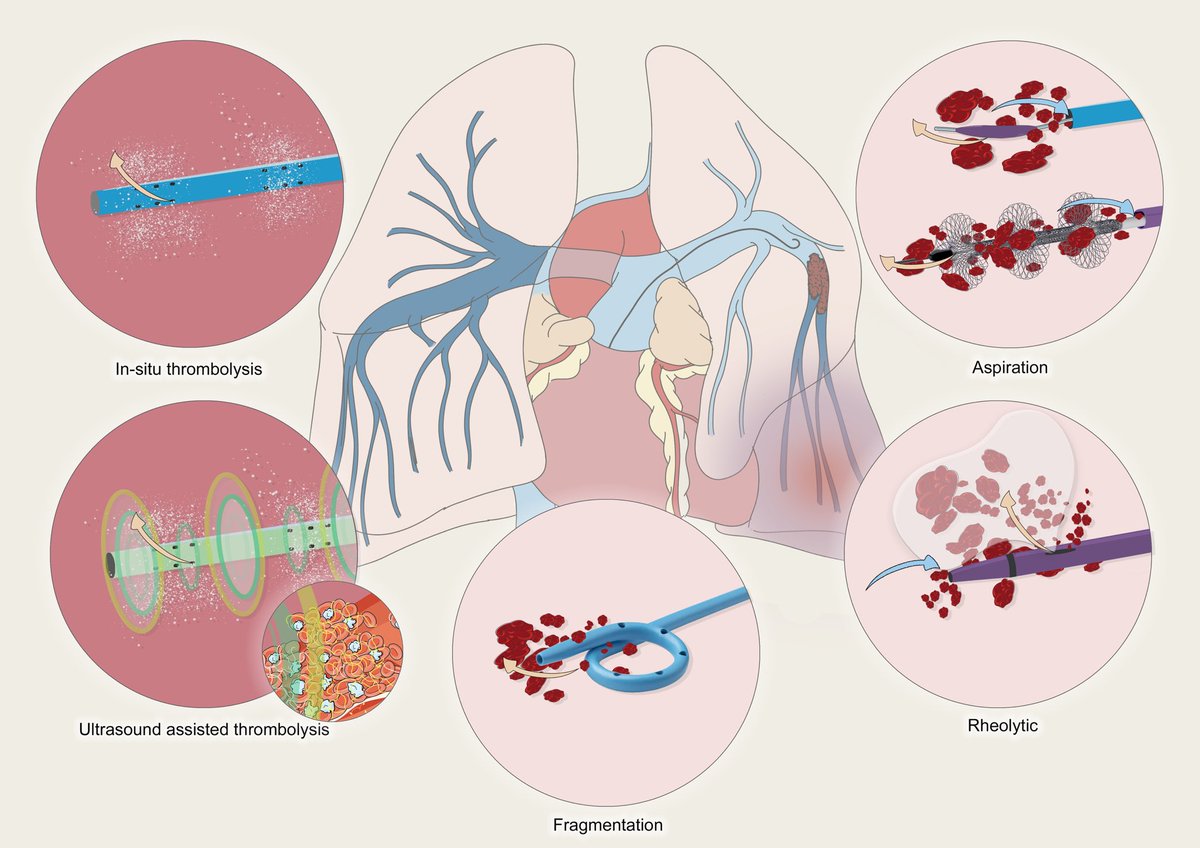 Percutaneous treatments for pulmonary embolism are emerging as alternatives to conventional therapies with recent data, and safety profiles endorsing a shift towards a “primary percutaneous pulmonary intervention” strategy, similar to that for ST-elevation myocardial infarction.