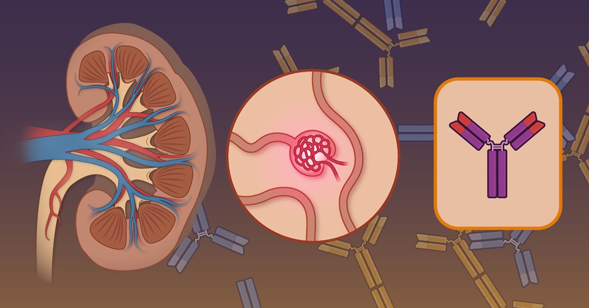 Patients with IgA nephropathy often progress to kidney failure despite standard treatment. Sibeprenlimab may block the immune cascade involved in IgA nephropathy. Research findings are summarized in a Quick Take video. nej.md/4aBZReR