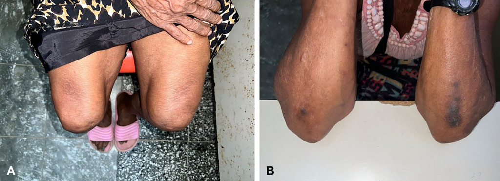 AnnalsofIMCC's tweet photo. A new image/video case from @ucatolica @unicahonduras shows a woman with thinker’s sign on both thighs and elbows, associated with clinical features of #COPD. Read more and view the case at https://t.co/DGxgppkT0z. @ACPIMPhysicians #AHAjournals @AHAScience https://t.co/loDaGqIKxE