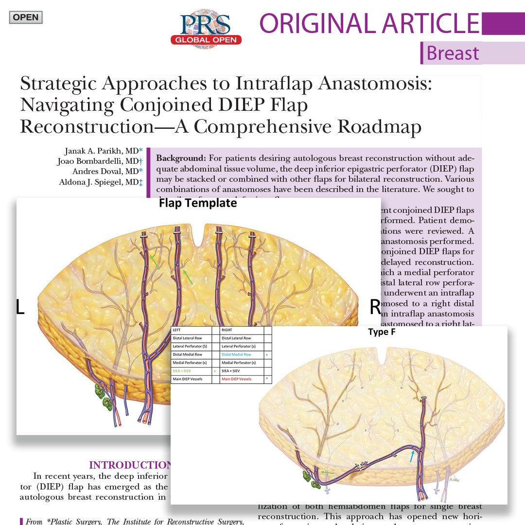 How can we help surgeons performing conjoined deep inferior epigastric perforator (#DIEP) flap #breastreconstruction to make intraoperative decisions on how to make their intraflap anastomosis. Read this #PRSGlobalOpen article to find out: bit.ly/49GI8lu