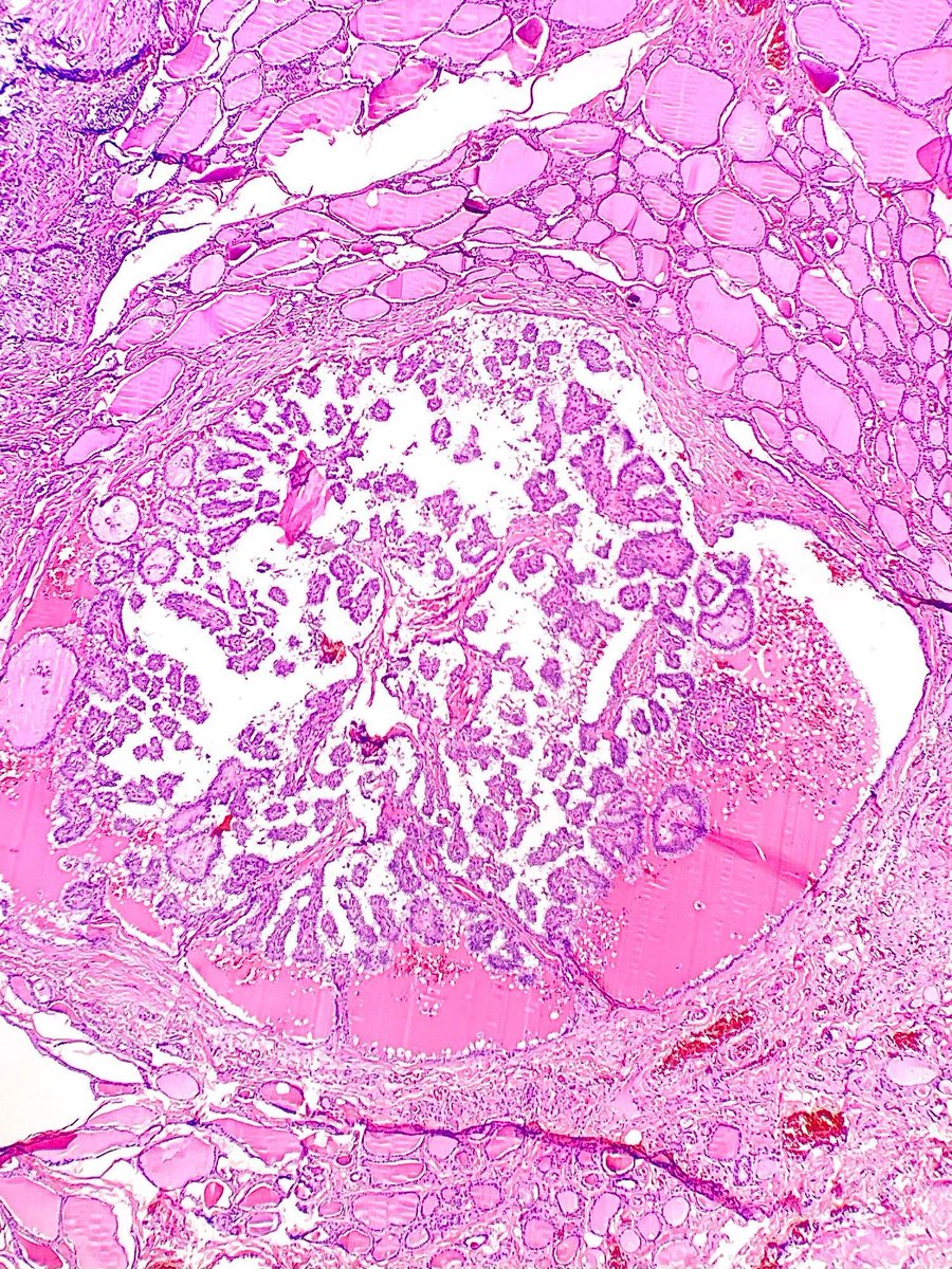 Thyroidectomy specimen revealing an incidental focus of what tumor type? Answer: buff.ly/3ScQsDC #PathArt #PathTwitter #MedTwitter