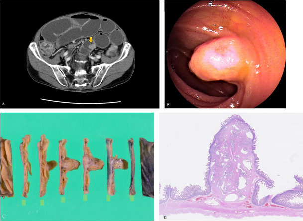 Image of the Month presents: Ectopic #Pancreas in the Small Intestine ow.ly/uJn150R54x8