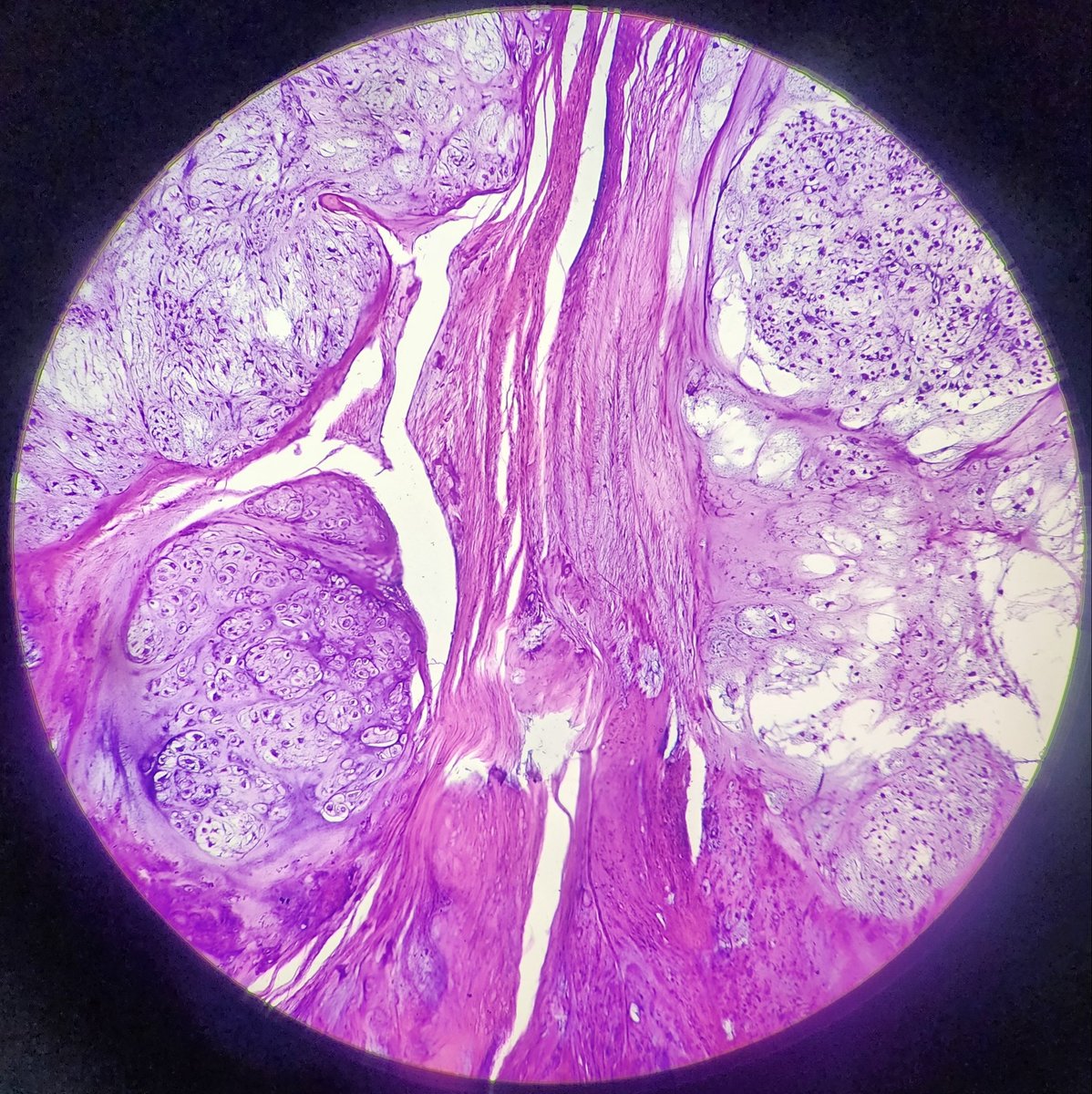 #Histopathology #bone #sarcoma #photomicrograph Dx: Chondrosarcoma.