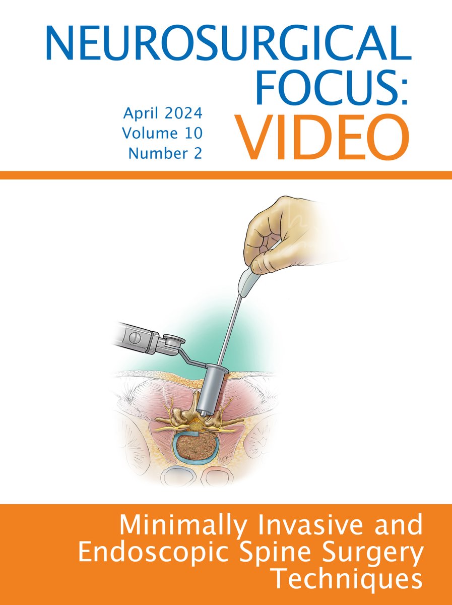 The April issue of @TheJNS's Neurosurgical Focus: Video features incredible work by Mark Mahan, MD, as lead editor!

Learn more about innovations in #minimallyinvasive and #endoscopic #spinesurgery techniques at
bit.ly/3VAWwaJ