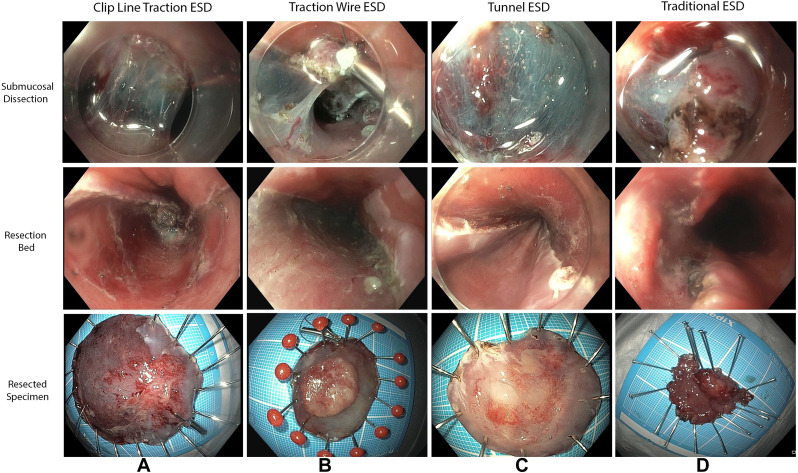 Online now in GIE’s Articles in Press: “Endoscopic submucosal dissection with versus without traction for pathologically staged T1B esophageal cancer: a multicenter retrospective study” by Abel Joseph et al. giejournal.org/article/S0016-… @amitbhattMD @abeljosephMD @prasadIyerMD