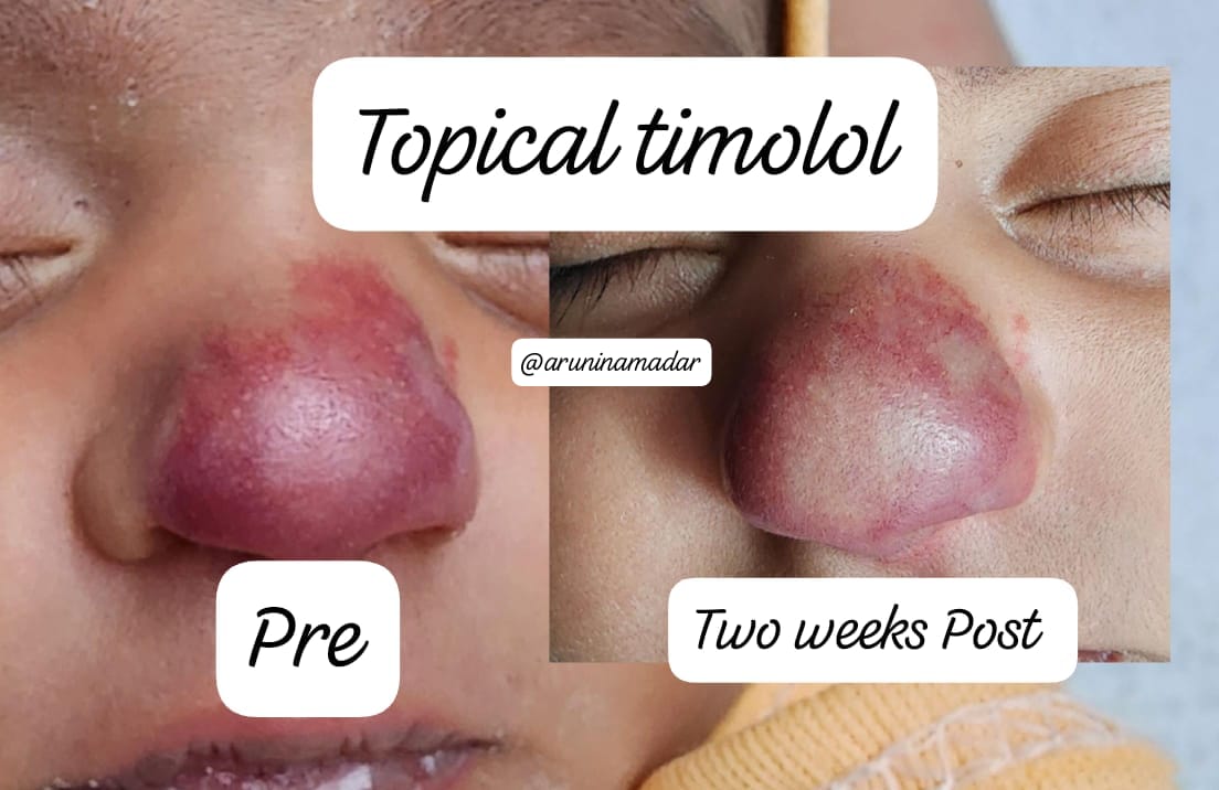Infantile haemangioma; colour change within two weeks of topical timolol application.... beta blockers , the best thing happened to Infantile haemangioma management