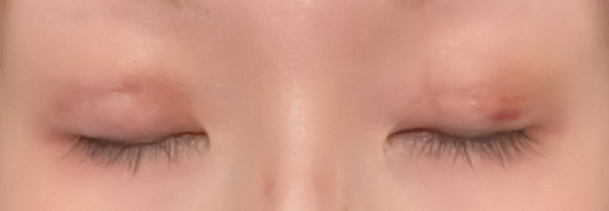 yuchap_p's tweet photo. ＊ Day 3 ＊

そんなに昨日と変化なし☁°
早く腫れ引かんかなぁ〜💭💭💭

幅ちゃんと狭くなるか心配🤔💭

内出血がちょっと紫と黄色に
変わったかな？？

まだ見開くのは目がしんどくなる🌀
伏し目で生活に慣れてきた(  ܸ..)⋆꙳

明日は出掛ける予定があるので
埋没後、初メイクする予定💄🤍🩵 https://t.co/BJzR3VS9PO