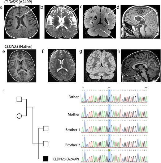 A loss of function mutation in CLDN25 causing Pelizaeus-Merzbacher-like leukodystrophy doi.org/10.1093/hmg/dd…