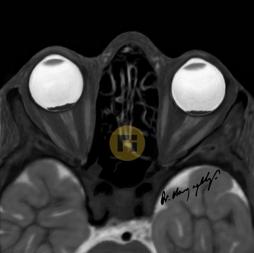 Abusive Head Trauma Retinal Hemorrhages #radiologicalillustration ✍️ pixel by pixel handmade!