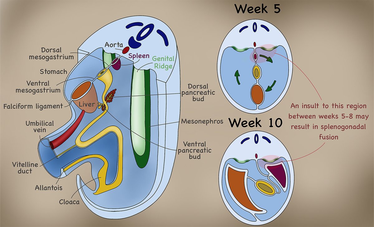 The latest Cases from the Cooky Jar highlights imaging findings of splenogonadal fusion, a rare congenital malformation that occurs during weeks 5-8 of gestation. bit.ly/3PwHBdW