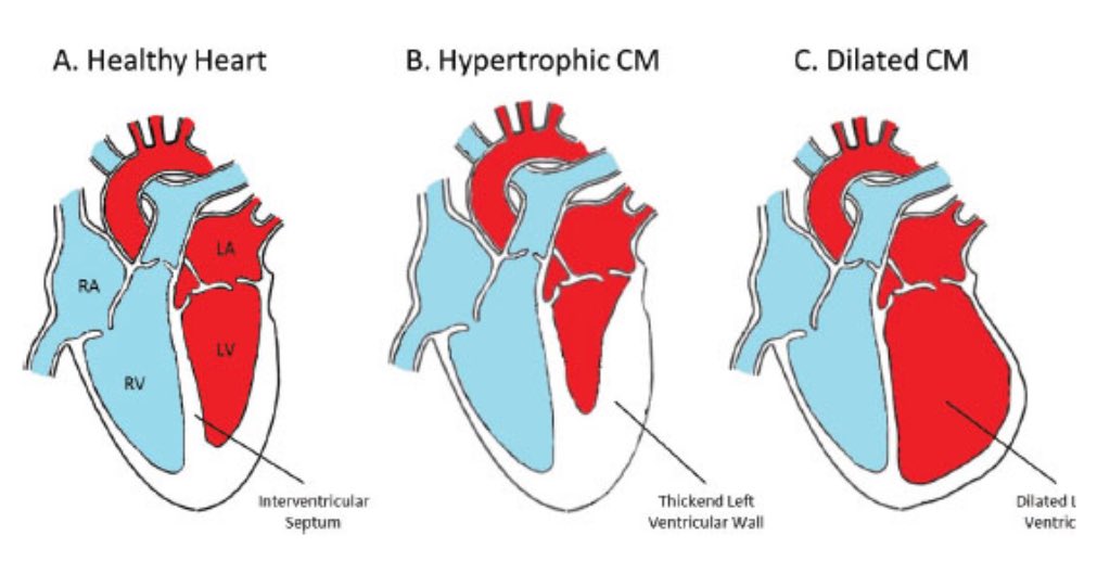 Hypertrophic cardiomyopathy: most commonly affected gene is MYH7 on 14q; implicated mutation is R403Q. 

Autosomal dominant dilated cardiomyopathy: most common MYH7 (same) gene mutation, encoding b-myosin heavy chain. X-linked dilated cardiomyopathy - dystrophin gene mutation.