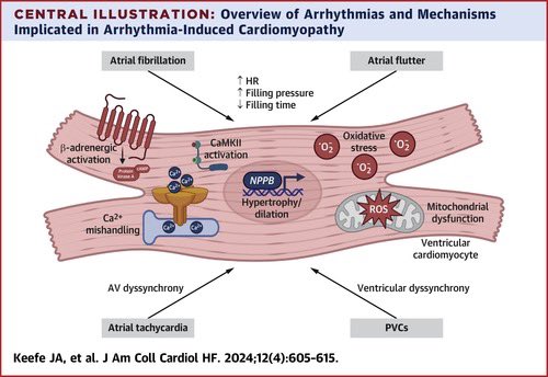 🔴 Tachycardia & Atrial Fibrillation-Related Cardiomyopathies: Potential Mechanisms & Current Therapies @JACCJournals #CardioEd #Cardiology #Cadiotwitter #Cardiox